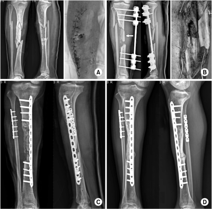 Compound fracture hesi case study